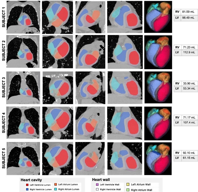 Cardiac Volumetry