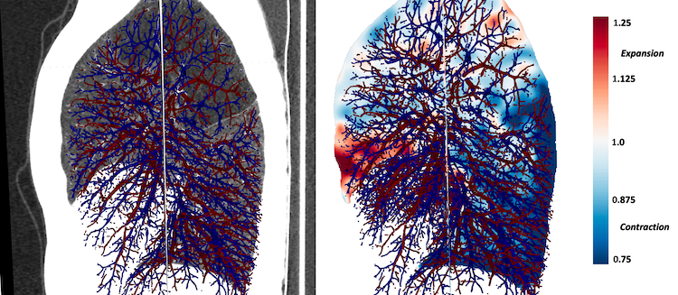 Functional Lung Assestment