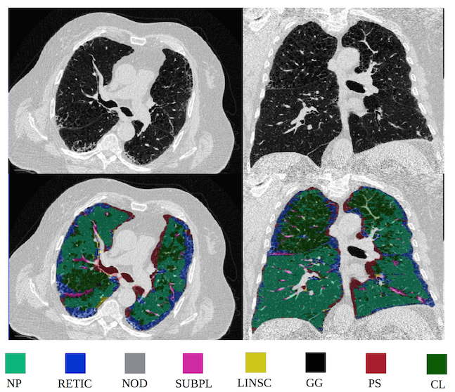 Parenchymal Injury