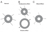 The Effect of Emphysema on Computed Tomographic Measures of Airway Dimensions in Smokers.